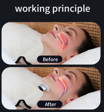 Smart Anti-Snoring Device – Throat Pulse Technology for Peaceful, Restful Sleep